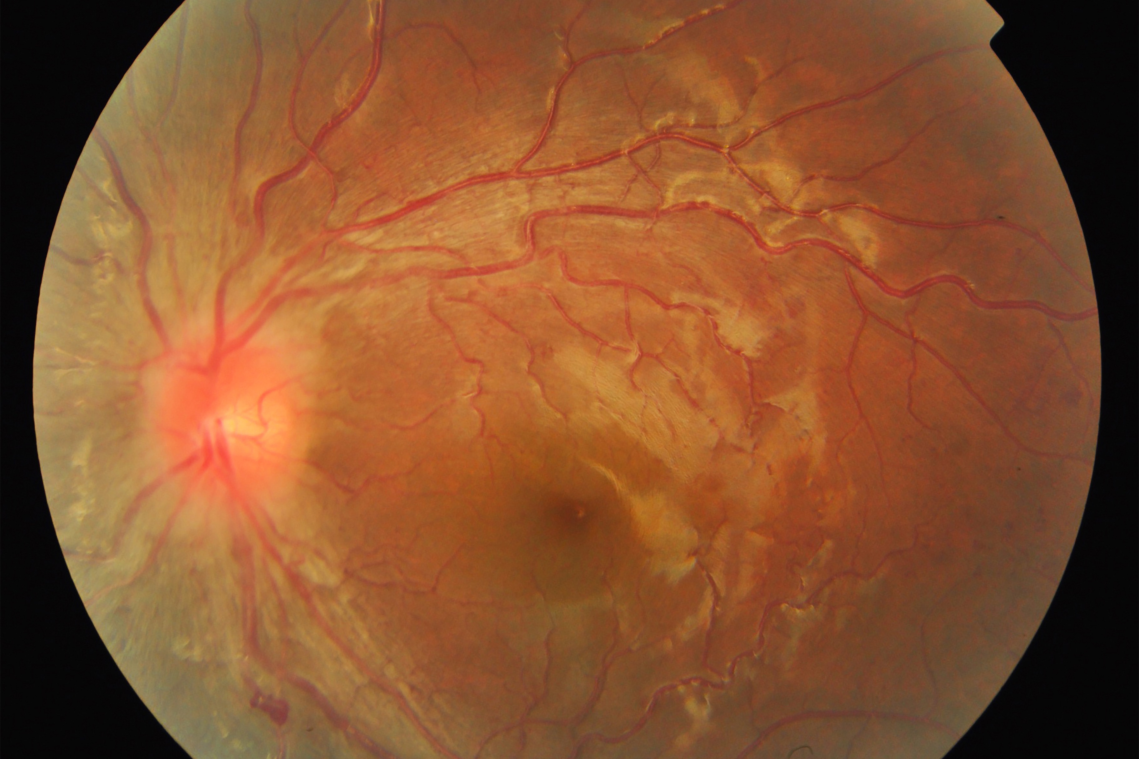 Fundus picture of the left eye